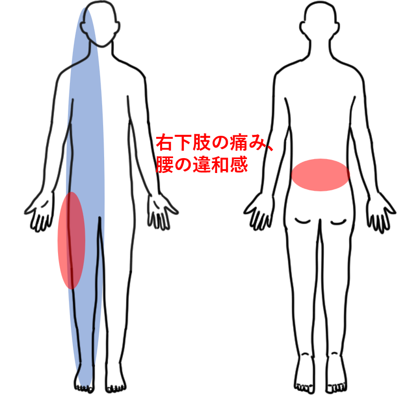 症状画像（腰椎ヘルニア）